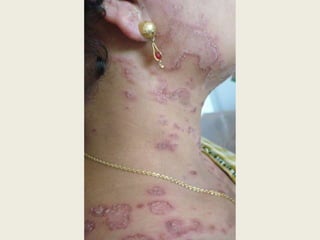   quando excessiva, aspecto de verrucosidadeLesão Elementar Secundárias – Alteração da consistência e/ou espessuraQueratose