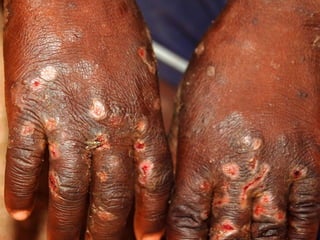 Lesão Elementar Secundárias – Alteração da consistência e/ou espessura4.2. Liquenificação  Espessamento da pele 