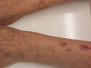   acentuação dos sulcos ou do quadriculado normal da pele