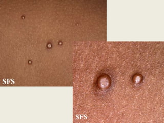   decorrente do ato de coçar