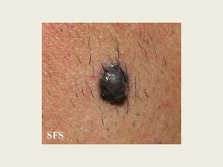   A liquenificação pode apresentar alterações da cor da peleLesão Elementar Secundárias – Alteração da consistência e/ou espessuraLiquenificação