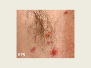 Lesão Elementar Secundárias – Alteração da consistência e/ou espessura4.3. EdemaExtravasamento de líquido na derme ou hipoderme, assumindo a coloração da pele ou apresentando eritema na superfície da lesão. 