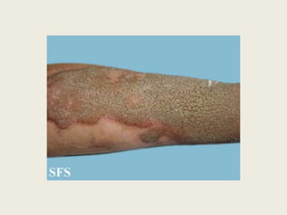 Lesão Elementar Secundárias – Alteração da consistência e/ou espessura4.4. Esclerose- Alteração da espessura ( atrofia) e da consistência da pele- Rígida, perde o pregueado e resiste à distensão enrugamento- lisa e brilhante- firme e endurecida : mais palpáveis do que visíveis- pele da superfície da esclerose é branca e brilhante, com perda total dos sulcos naturais. 