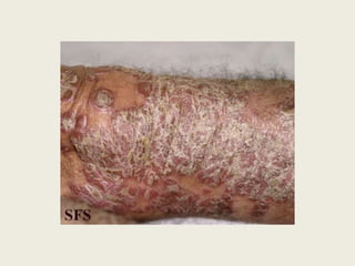 Lesão Elementar Secundárias – Alteração da consistência e/ou espessura4.5. AtrofiaAdelgaçamento da pele