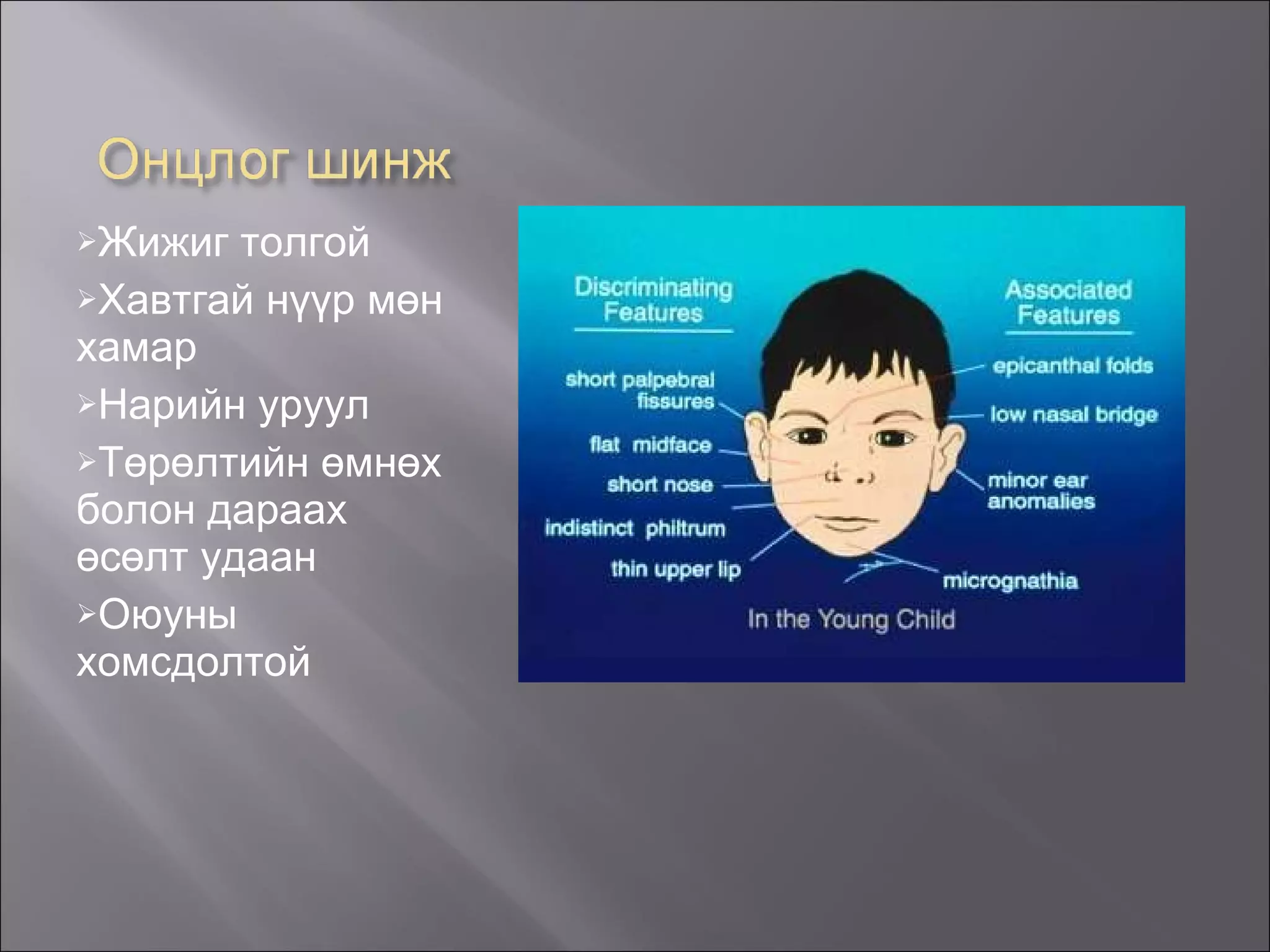 Жижиг толгой Хавтгай нүүр мөн хамар Нарийн уруул Төрөлтийн өмнөх болон дараах өсөлт удаан Оюуны хомсдолтой 