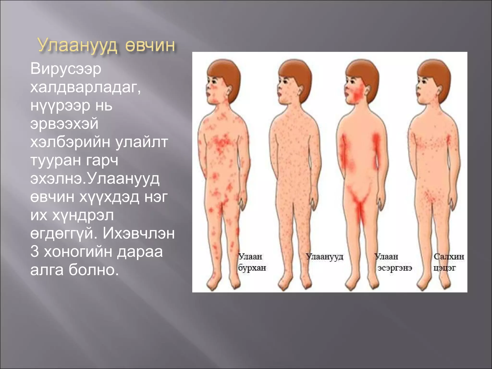 Вирусээр халдварладаг, нүүрээр нь эрвээхэй хэлбэрийн улайлт тууран гарч эхэлнэ.Улаанууд өвчин хүүхдэд нэг их хүндрэл өгдөггүй. Ихэвчлэн 3 хоногийн дараа алга болно. 