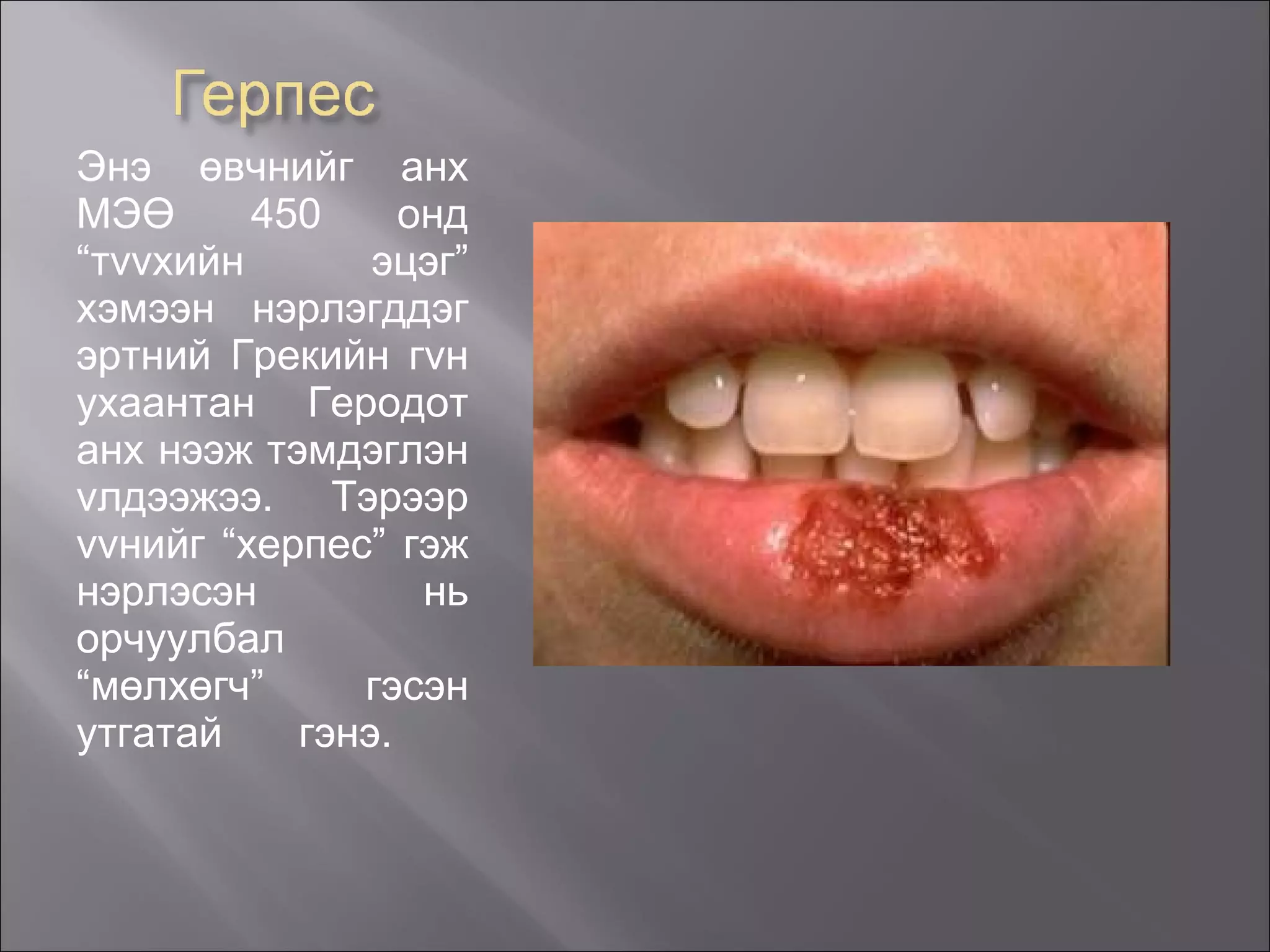 Энэ өвчнийг анх МЭӨ 450 онд “т vv хийн эцэг” хэмээн нэрлэгддэг эртний Грекийн г v н ухаантан Геродот анх нээж тэмдэглэн  v лдээжээ. Тэрээр  vv нийг “херпес” гэж нэрлэсэн нь орчуулбал “мөлхөгч” гэсэн утгатай гэнэ.  