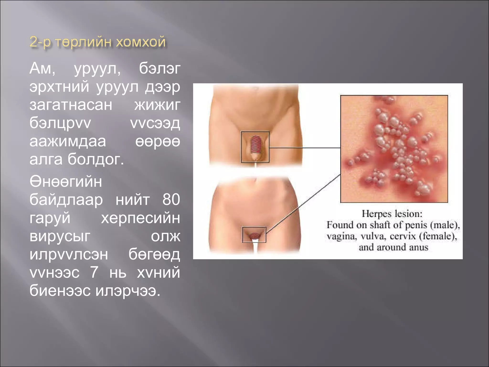 Ам, уруул, бэлэг эрхтний уруул дээр загатнасан жижиг бэлцр vv vv сээд аажимдаа өөрөө алга болдог. Өнөөгийн байдлаар нийт 80 гаруй херпесийн вирусыг олж илр vv лсэн бөгөөд  vv нээс 7 нь х v ний биенээс илэрчээ.   