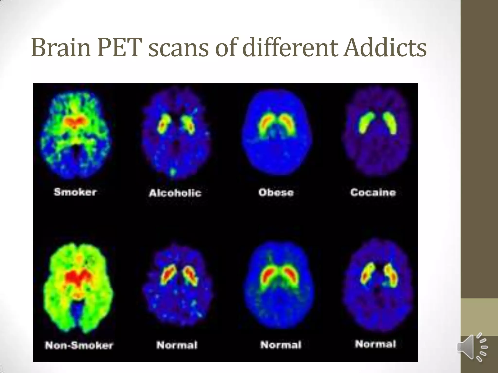 Brain PET scans of different Addicts
 