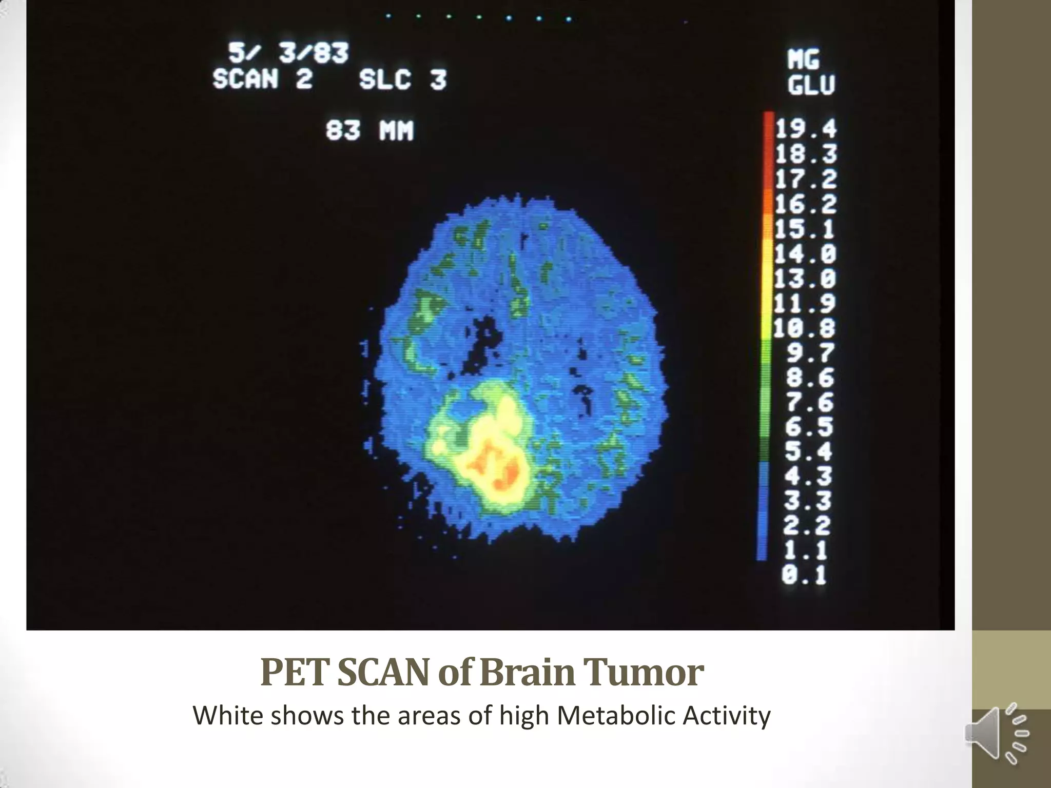 PETSCANofBrainTumor
White shows the areas of high Metabolic Activity
 
