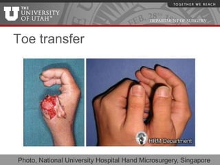 DEPARTMENT OF SURGERY



Toe transfer




Photo, National University Hospital Hand Microsurgery, Singapore
 