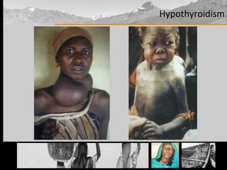 Hypothyroidism 