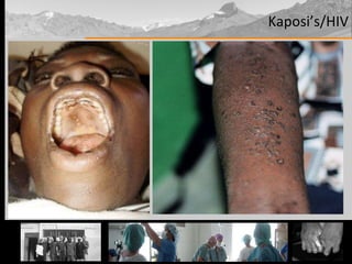 Kaposi’s/HIV 