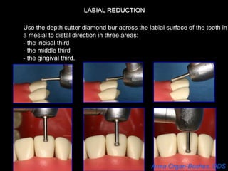 Veneer Preparation and Provisional | PPT