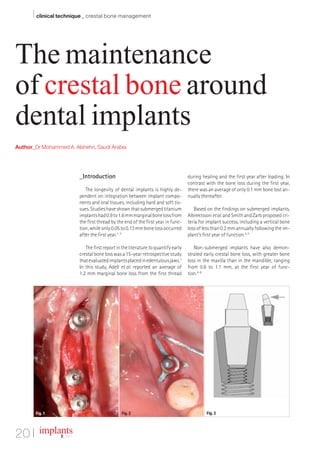 I clinical technique _ crestal bone management


The maintenance
of crestal bone around
dental implants
Author_Dr Mohammed A. Alshehri, Saudi Arabia




                            _Introduction                                             during healing and the first year after loading. In
                                                                                      contrast with the bone loss during the first year,
                               The longevity of dental implants is highly de-         there was an average of only 0.1 mm bone lost an-
                            pendent on integration between implant compo-             nually thereafter.
                            nents and oral tissues, including hard and soft tis-
                            sues. Studies have shown that submerged titanium             Based on the findings on submerged implants,
                            implants had 0.9 to 1.6 mm marginal bone loss from        Albrektsson et al. and Smith and Zarb proposed cri-
                            the first thread by the end of the first year in func-    teria for implant success, including a vertical bone
                            tion, while only 0.05 to 0.13 mm bone loss occurred       loss of less than 0.2 mm annually following the im-
                            after the first year.1–3                                  plant’s first year of function.4, 5

                               The first report in the literature to quantify early      Non-submerged implants have also demon-
                            crestal bone loss was a 15-year retrospective study       strated early crestal bone loss, with greater bone
                            that evaluated implants placed in edentulous jaws.1       loss in the maxilla than in the mandible, ranging
                            In this study, Adell et al. reported an average of        from 0.6 to 1.1 mm, at the first year of func-
                            1.2 mm marginal bone loss from the first thread           tion.6–8




        Fig. 1                                    Fig. 2                                       Fig. 3




20 I implants     2_ 2011
 