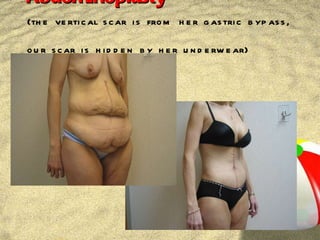 Abdominoplasty  (the vertical scar is from her gastric bypass, our scar is hidden by her underwear) 
