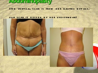 Abdominoplasty (the vertical scar is from her gastric bypass, our scar is hidden by her underwear) 