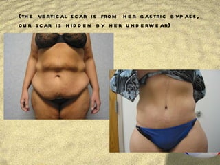 (the vertical scar is from her gastric bypass, our scar is hidden by her underwear) 