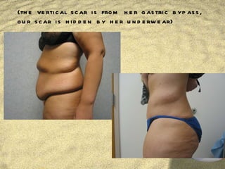 (the vertical scar is from her gastric bypass, our scar is hidden by her underwear) 
