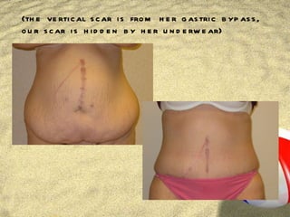 (the vertical scar is from her gastric bypass, our scar is hidden by her underwear) 