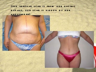 (the vertical scar is from her gastric bypass, our scar is hidden by her underwear) 