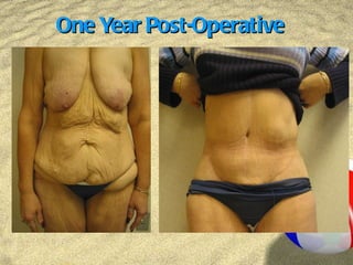 One Year Post-Operative 