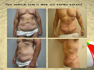 (the vertical scar is from his gastric bypass) 