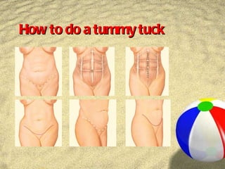How to do a tummy tuck 