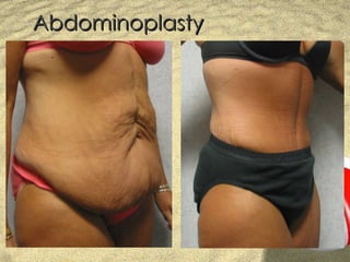 Abdominoplasty 