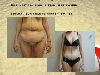 Abdominoplasty (the vertical scar is from her gastric bypass, our scar is hidden by her underwear) 