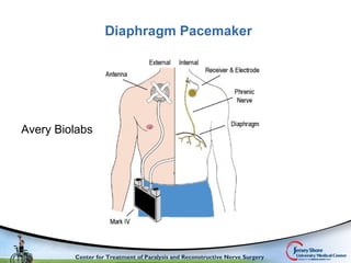 Comprehensive surgical management of the paralyzed diaphragm | PPT