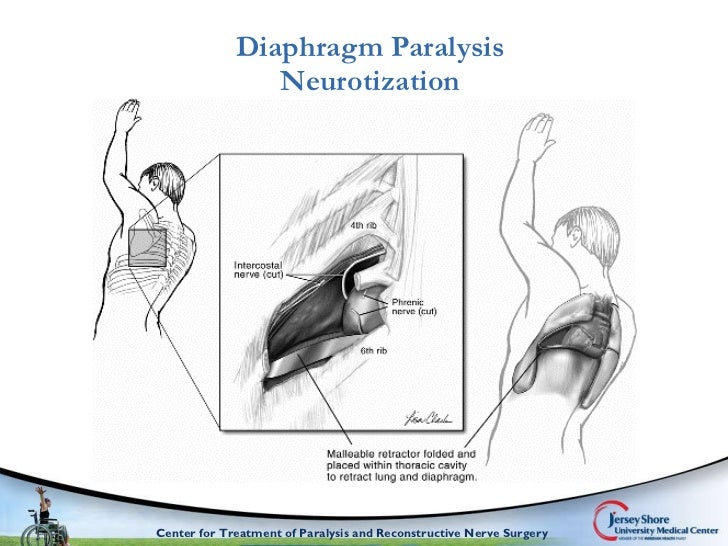 Comprehensive surgical management of the paralyzed diaphragm