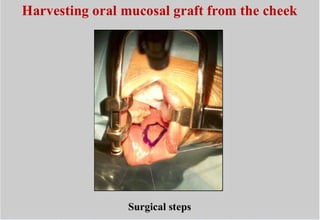 harvesting oral buccal mucosa