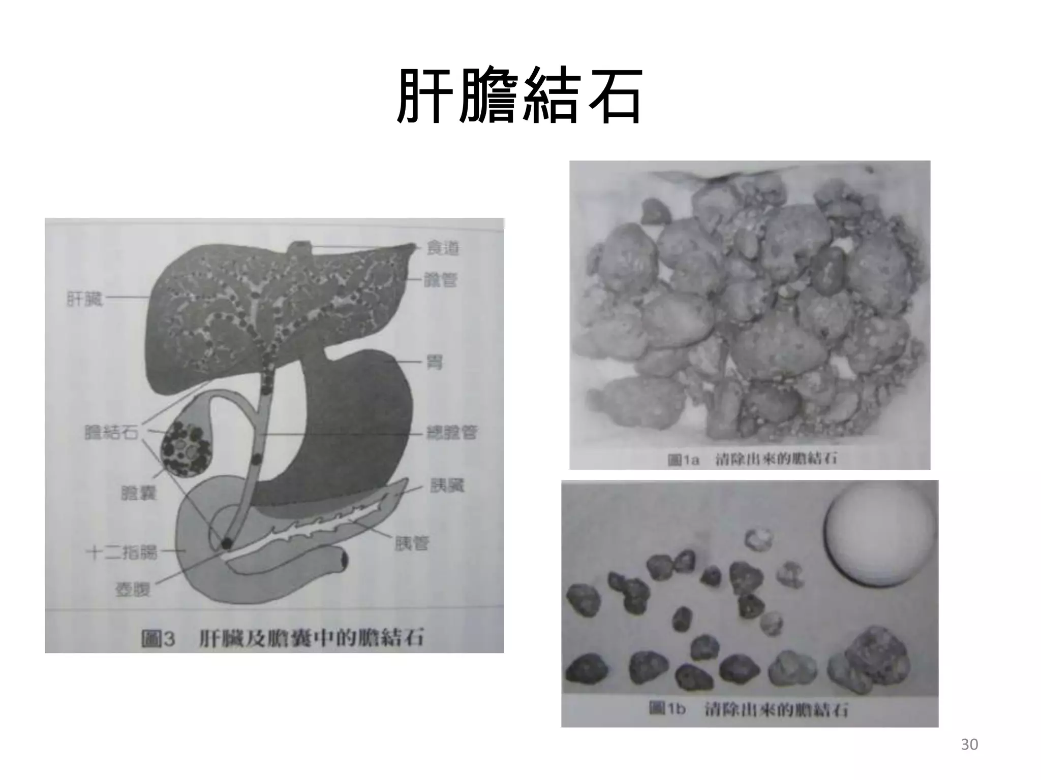 肝膽結石




       30
 