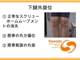 下腿外旋位
① 正常なスクリュー
　ホームムーブメン
トの消失

② 脛骨の外方偏位

③ 脛骨粗面の外旋
 