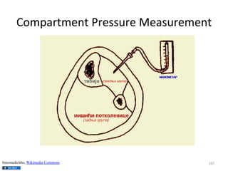 Compartment	
  Pressure	
  Measurement	
  

Intermedichbo, Wikimedia Commons

107	
  

 