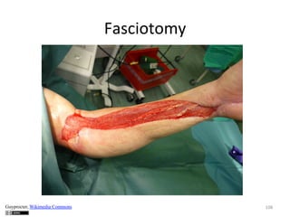 Fasciotomy	
  

Guyprocter, Wikimedia Commons

108	
  

 