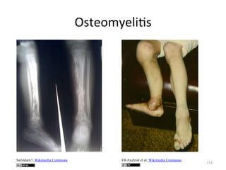 Osteomyeli(s	
  

Sarindam7, Wikimedia Commons

FB Axelrod et al, Wikimedia Commons

111	
  

 