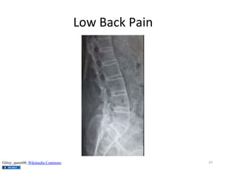 Low	
  Back	
  Pain	
  

Glitzy_queen00, Wikimedia Commons

47	
  

 