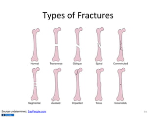 Types	
  of	
  Fractures	
  

Source undetermined, SayPeople.com

59	
  

 