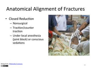 Anatomical	
  Alignment	
  of	
  Fractures	
  
•  Closed	
  Reduc(on	
  
–  Nonsurgical	
  
–  Trac(on/counter	
  
trac(on	
  
–  Under	
  local	
  anesthesia	
  
(joint	
  block)	
  or	
  conscious	
  
seda(ons	
  

Bobjgalindo, Wikimedia Commons

62	
  

 