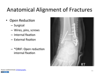 Anatomical	
  Alignment	
  of	
  Fractures	
  
•  Open	
  Reduc(on	
  
–  Surgical	
  	
  
–  Wires,	
  pins,	
  screws	
  
–  Internal	
  ﬁxa(on	
  
–  External	
  ﬁxa(on	
  
–  *ORIF:	
  Open	
  reduc(on	
  
internal	
  ﬁxa(on	
  

Source undetermined, E-Radiography

63	
  

 