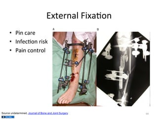 External	
  Fixa(on	
  
•  Pin	
  care	
  
•  Infec(on	
  risk	
  
•  Pain	
  control	
  

Source undetermined, Journal of Bone and Joint Surgery

64	
  

 