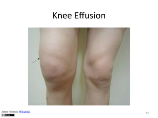 Knee	
  Eﬀusion	
  

James Heilman, Wikipedia

83	
  

 