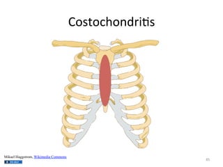 Costochondri(s	
  

Mikael Haggstrom, Wikimedia Commons

85	
  

 