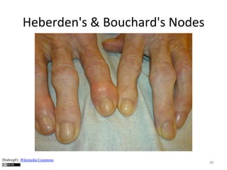 Heberden's	
  &	
  Bouchard's	
  Nodes	
  

Drahreg01, Wikimedia Commons

88	
  

 