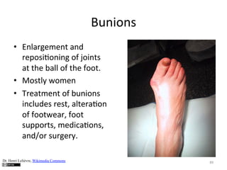 Bunions	
  
•  Enlargement	
  and	
  
reposi(oning	
  of	
  joints	
  
at	
  the	
  ball	
  of	
  the	
  foot.	
  	
  
•  Mostly	
  women	
  
•  Treatment	
  of	
  bunions	
  	
  
includes	
  rest,	
  altera(on	
  
of	
  footwear,	
  foot	
  
supports,	
  medica(ons,	
  
and/or	
  surgery.	
  	
  
Dr. Henri Lelièvre, Wikimedia Commons

89	
  

 
