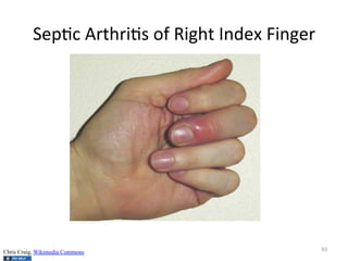Sep(c	
  Arthri(s	
  of	
  Right	
  Index	
  Finger	
  

Chris Craig, Wikimedia Commons

93	
  

 