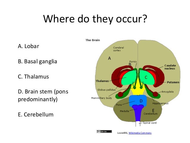 GEMC: Intracerebral Hemorrhage (ICH): Resident Training
