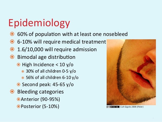 GEMC: Evaluation and Management of Epistaxis: Resident Training GEMC: Evaluation and Management of Epistaxis: Resident Training